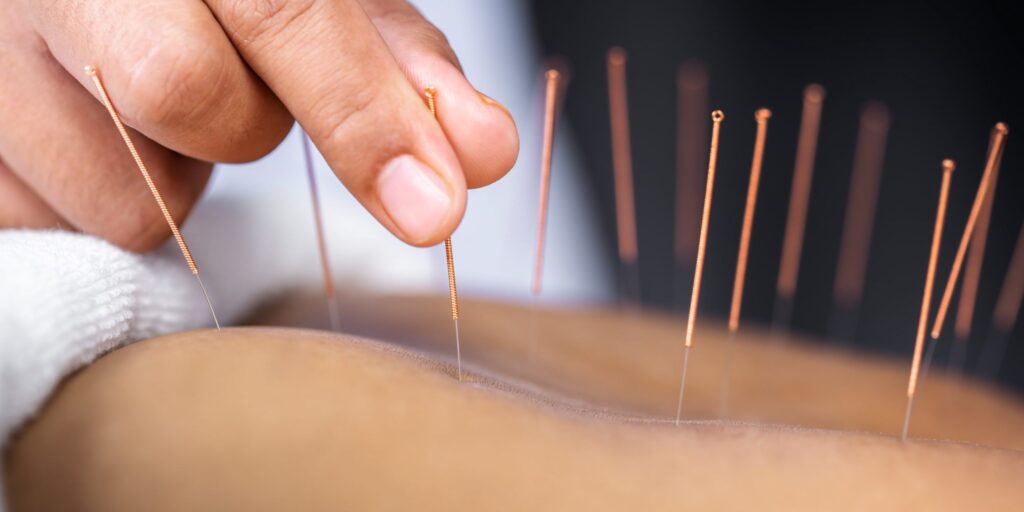 Acupuncture (एक्यूपंक्चर)