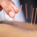 Acupuncture (एक्यूपंक्चर)